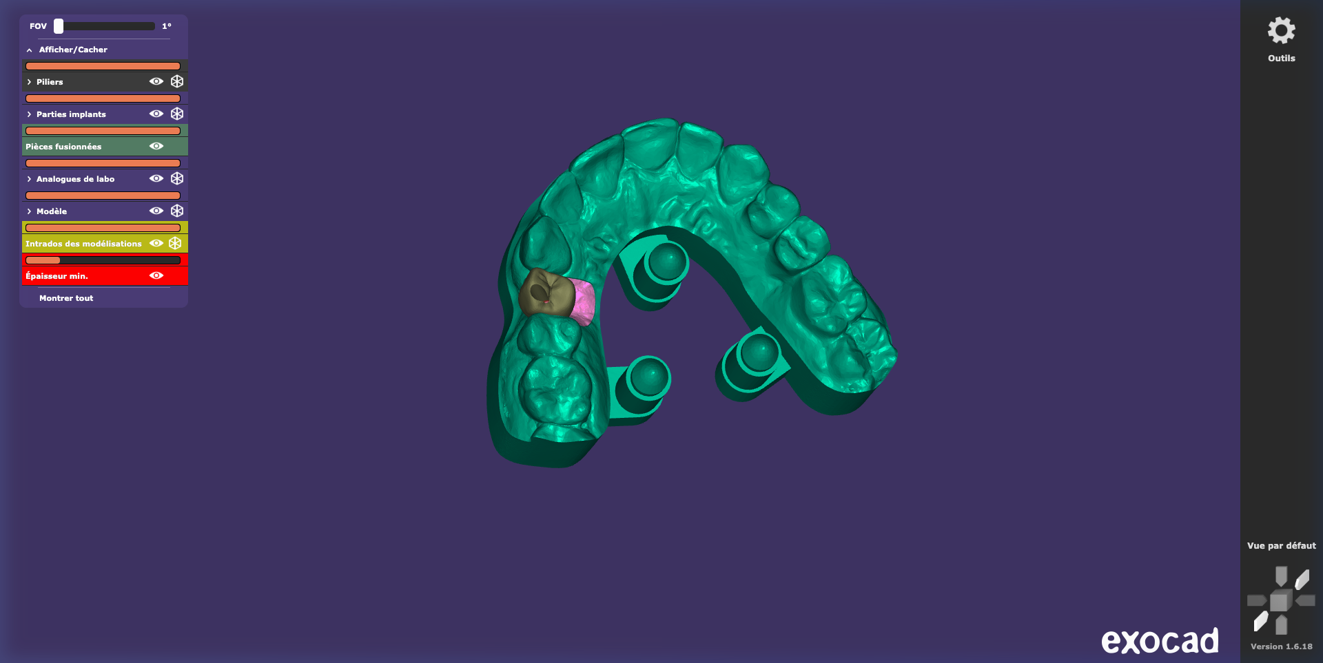 Couronne sur Ti-Base — Vue 3D