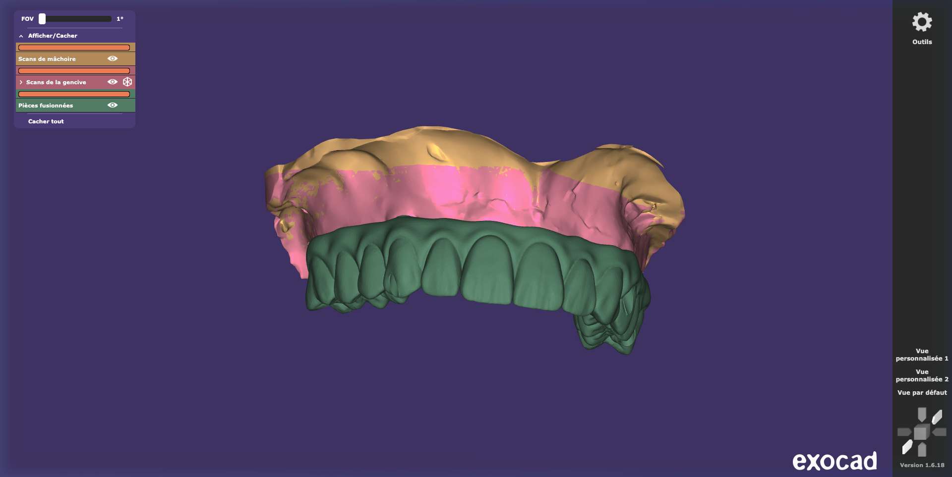 Full Arch Implants Supérieure variante — Vue 3D